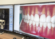 インプラント治療